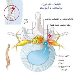 فتق دیسک کمر دیسک کمر و سیاتیک